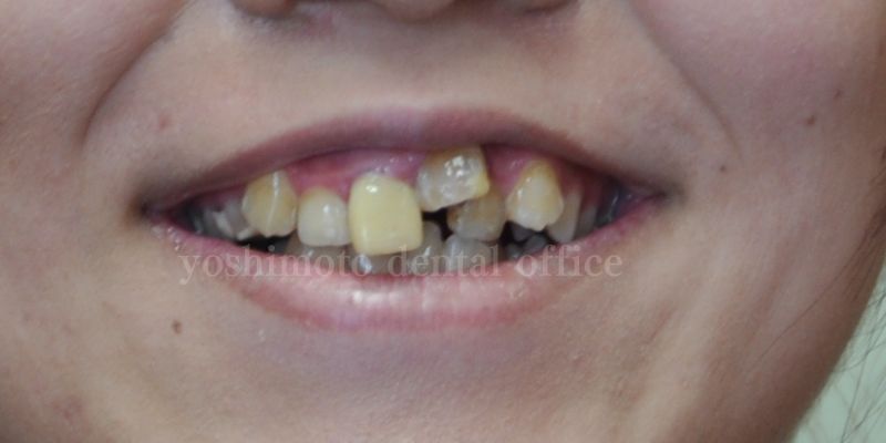 矯正をせずに歯並びを短期間で治すセラミックブリッジなら高松市の審美歯科　吉本歯科医院