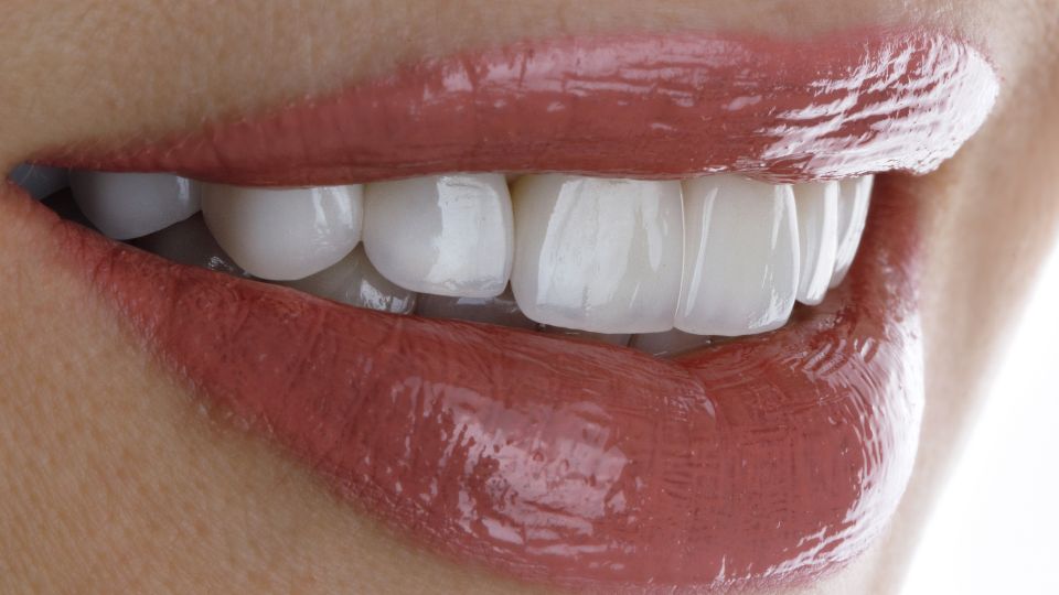 前歯を白くするラミネートべニアなら高松市の審美歯科なら吉本歯科医院