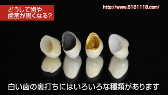 高松市の審美歯科なら吉本歯科医院|歯茎が黒ずんできた