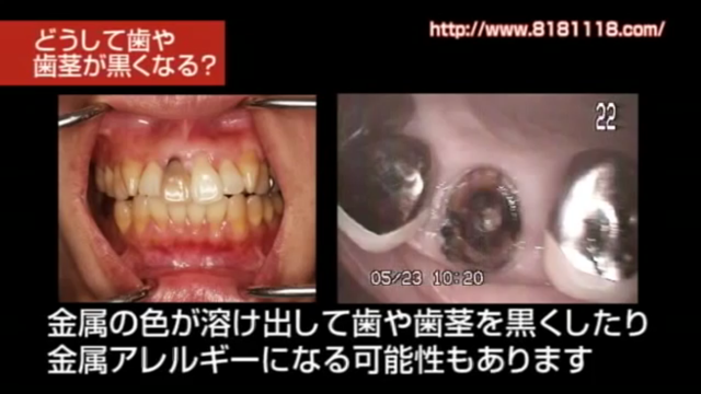 高松市の審美歯科なら吉本歯科医院｜歯茎が黒ずんできた